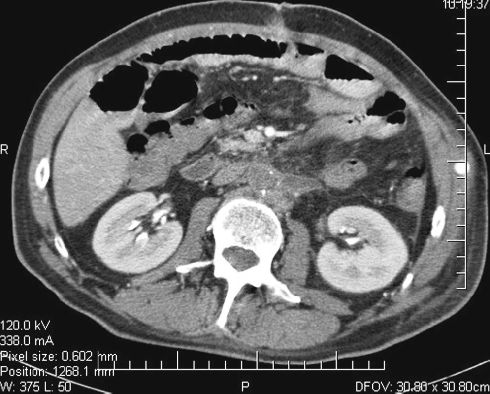 Pooperační CT: nejsou známky abscesu v retroperitoneu po explantaci infikované protézy. Laterálně vlevo v příčném řezu zachycený průchodný axilobifemorální bypass nestlačitelnou protézou vedený podkožím
Fig. 3. Postoperative CT: there are no signs of an abscess in the retroperitoneum after removal of the infected prosthesis. Laterally left in a transverse slice there is a patent axillobifemoral bypass with an incompressible prosthesis passing through a subcutaneous tunnel