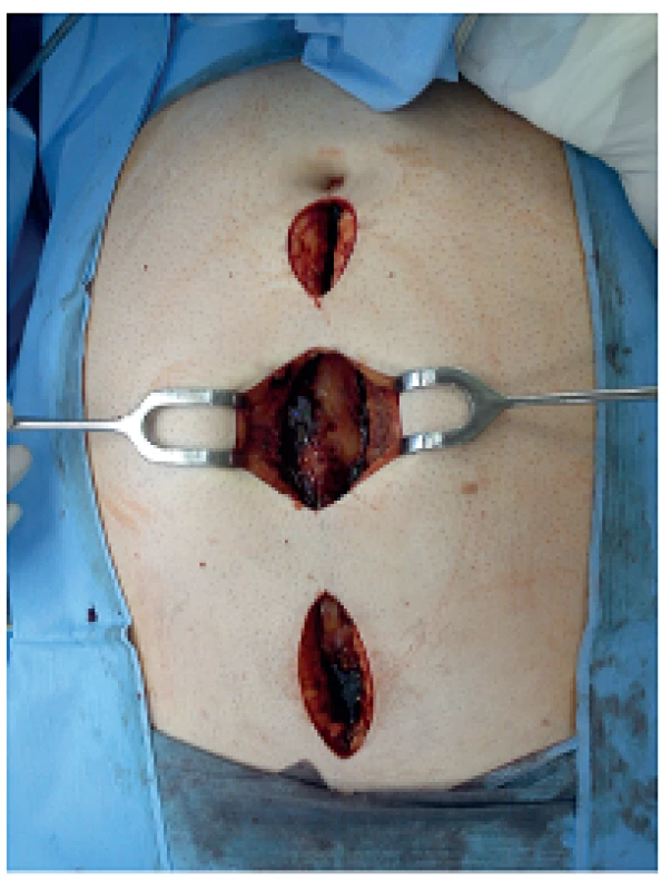 Fasciotomie v linea alba při intraabdominální hypertenzi
Fig. 5: Linea alba fasciotomy for abdominal compartment syndrome