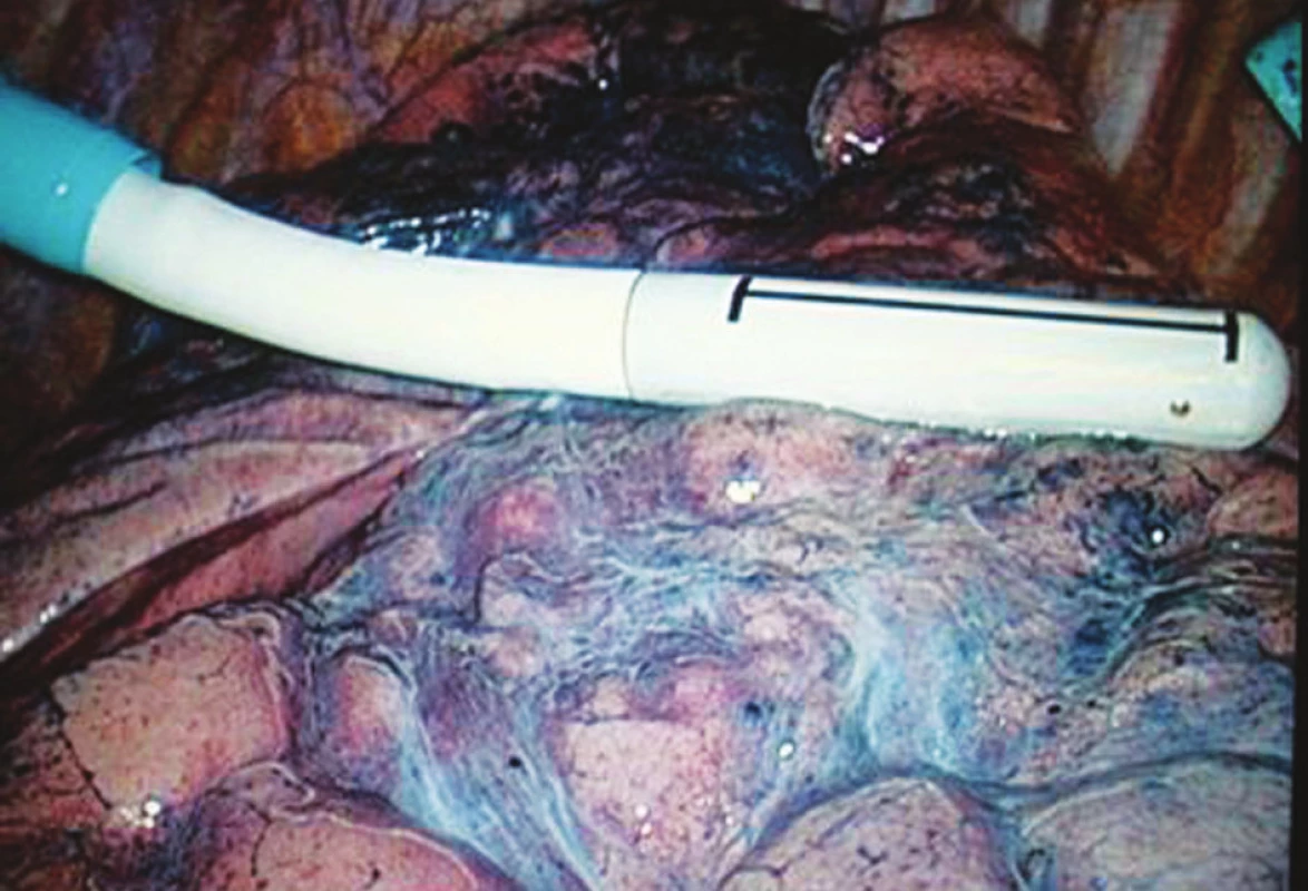 Peroperační ultrazvukové vyšetření plic endoskopickou sondou
Pic. 3. Peroprative ultrasonographic examination of the lungs by endoscopic probe