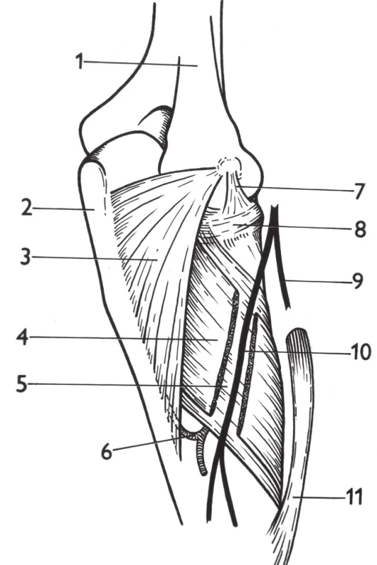 Canalis supinatorius: 1 – humerus, 2 – ulna, 3 – m. anconeus, 4 – povrchová vrstva m. supinator, 5 – hluboká vrstva m. supinator, 6 – a. interossea recurrens, 7 – lig. collaterale lat., 8 – lig. anulare radii, 9 – r. superficialis n. radialis, 10 – r. profundus n. radialis, 11 – m. pronator teres. <i>(Převzato z Bartoníček J. Operační přístupy u zlomenin hlavičky a diafýzy rádia. Acta Chir Orthop Traumatol Cech 1988;55:497–516.)</i>
Fig. 6: Supinator channel: 1 – humerus, 2 – ulna, 3 – anconeus, 4 – superficial layer of the supinator, 5 – deep layer of the supinator, 6 – interosseous recurrent artery, 7 – lateral collateral ligament, 8 – radial annular ligament, 9 – superficial branch of the radial nerve, 10 – deep branch of the radial nerve, 11 – pronator teres. <i>(Reprinted from Bartoníček J. [Surgical approaches in fractures of the head and shaft of radius]. Acta Chir Orthop Traumatol Cech 1988;55:497–516.)</i>