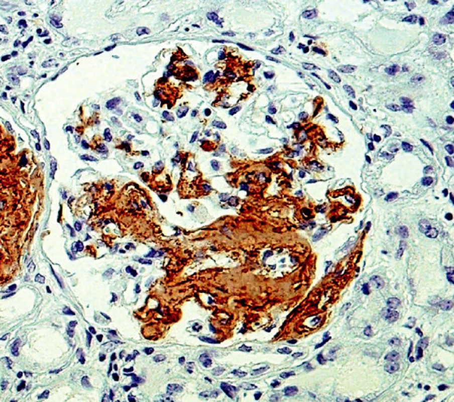 Imunohistochemický průkaz AA amyloidu – plošné pozitivity v glomerulu (objektiv 40krát)
