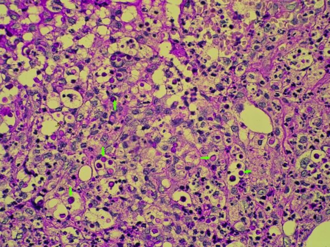 Cryptococcus neoformans – kvasinkovité struktury kryptokoků s PAS + hlenovou kapsulou (barvení PAS 400×, označeny šipkami).
Fig. 6. Cryptococcus neoformans – yeast like cryptococcus pattern with PAS positivity and mucus capsule (arrows). Staining: PAS, magnification 400×.