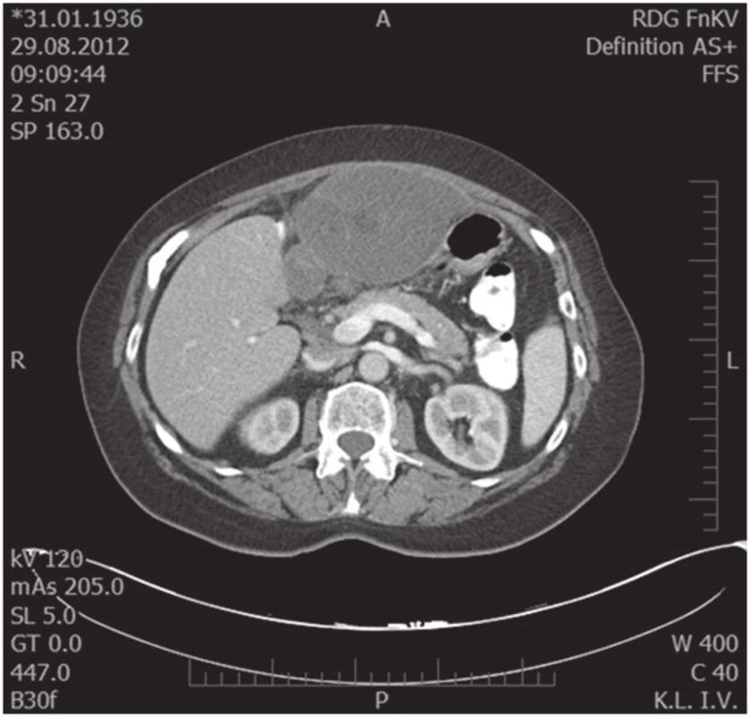 Předoperační MDCT scan, transverzální snímek
Fig. 3. Preoperative MDCT scan, transversal scan