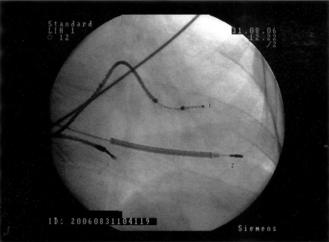 Implantace kardiostimulační elektrody do pravé komory.