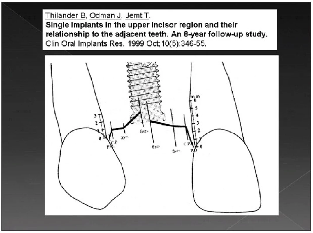 Posun zubů vzhledem k poloze zubního implantátu během 8 let sledování. Převzato z: Thilander B., Odman J., Jemt T.: Single implants in the upper incisor region and their relationship to the adjacent teeth. An 8-year follow-up study. Clin. Oral Implants Res. 10, 1999, 5, s. 346-55 [7].