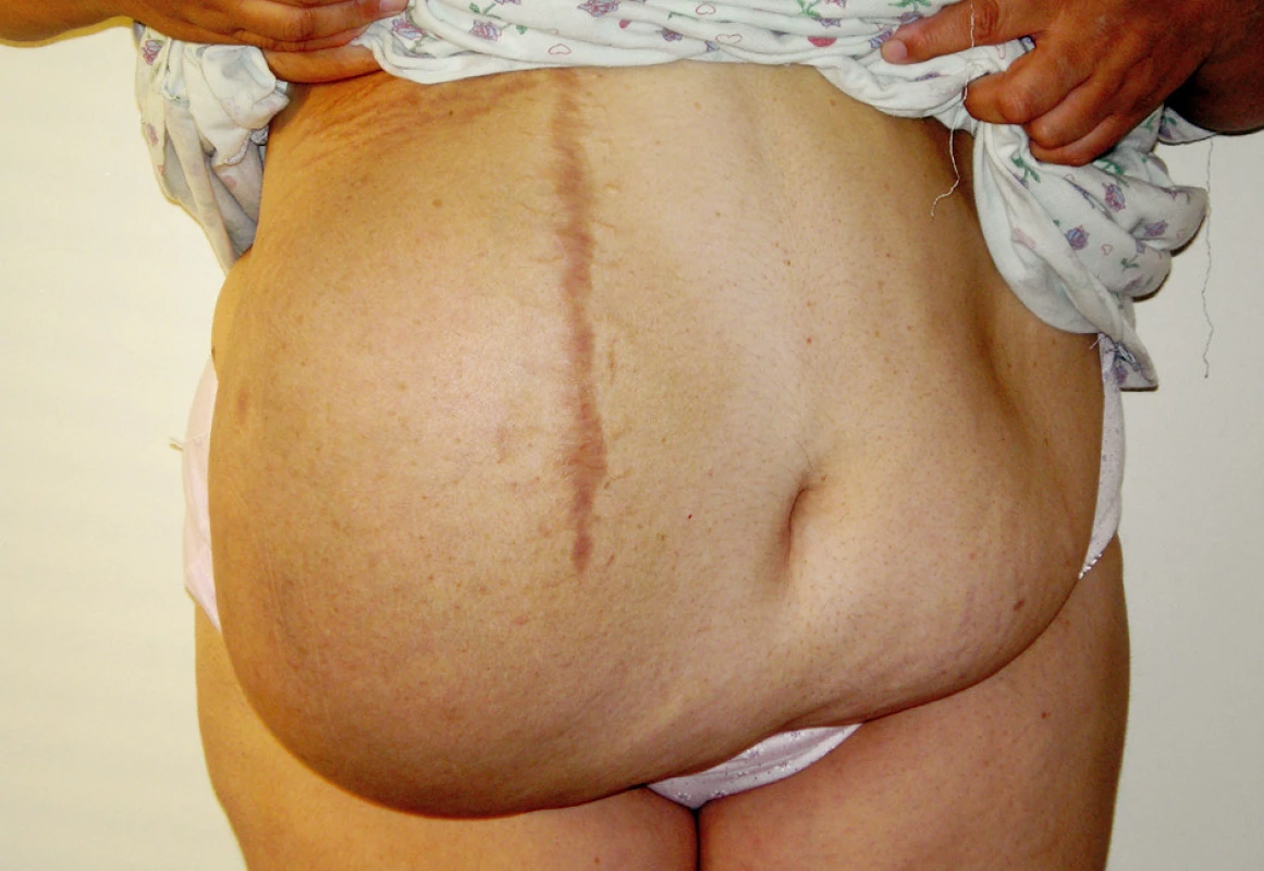 Incizionálna hernia v jazve po cholecystektómii
Fig. 4. Post-cholecystectomy incisional hernia
