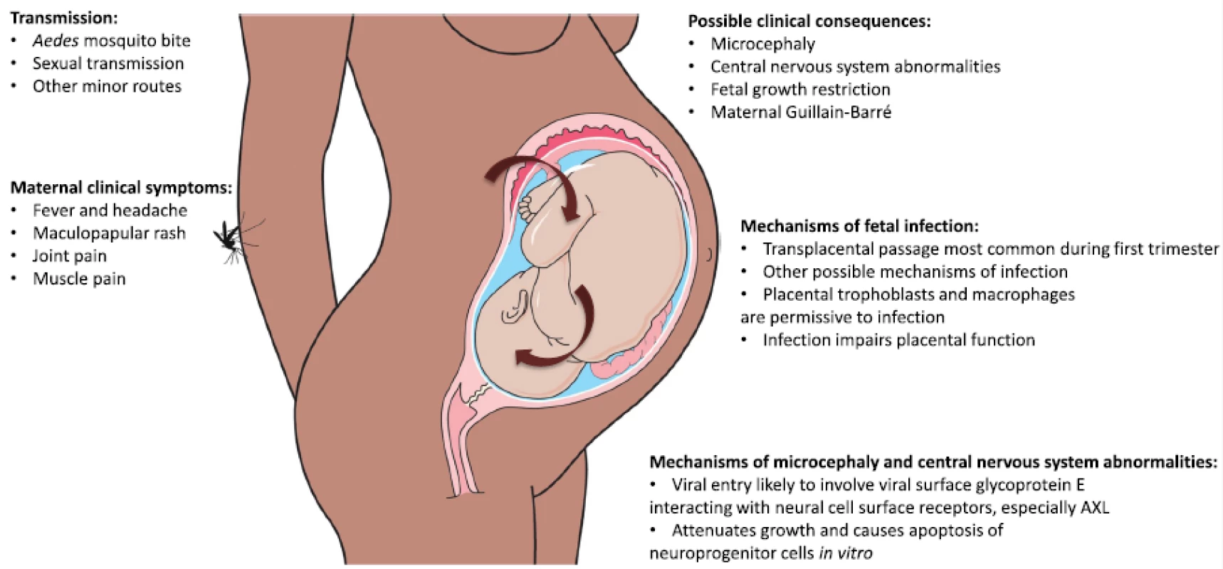 Zika virus disease pathogenesis. The figure summarizes key points regarding ZIKV transmission, clinical features and complications, and mechanisms of fetal infection and microcephaly and central nervous system abnormalities