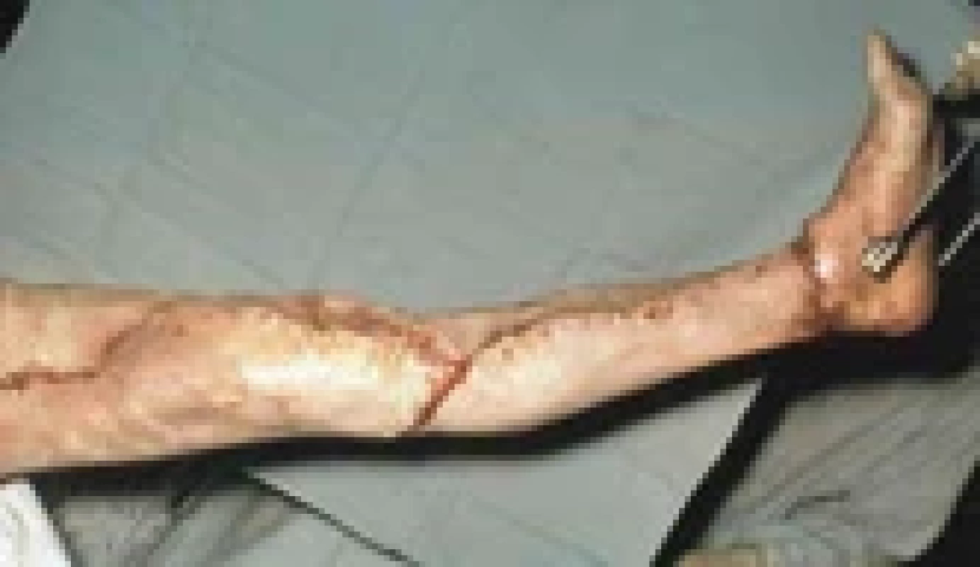 Skin graft applied to the defect of lower limb 3 days after original surgery.
