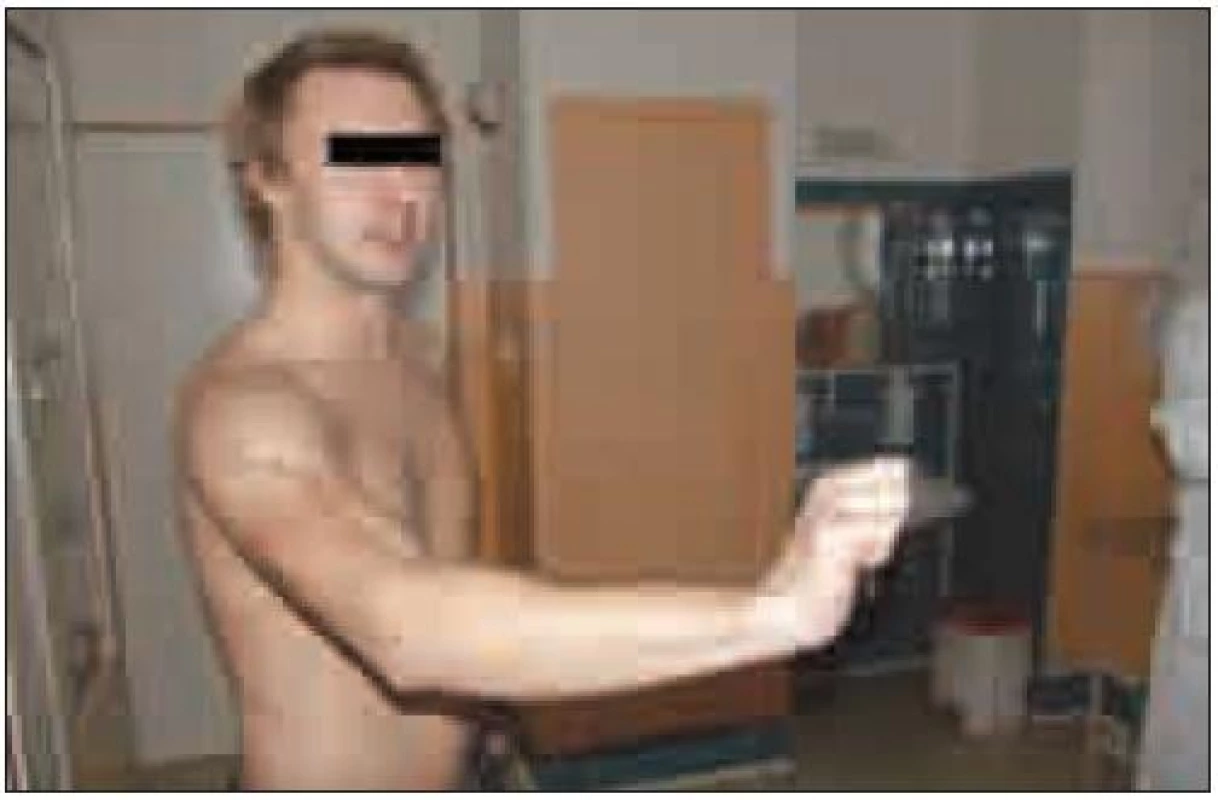 Foto pacienta: dva roky po neurochirurgické operaci s dobrou funkcí n. radialis.
