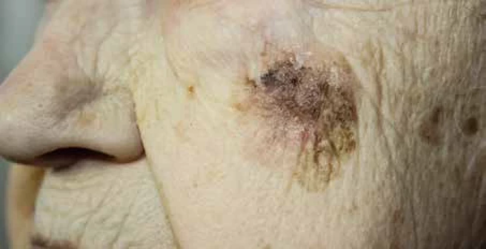 Lentigo maligna melanoma.