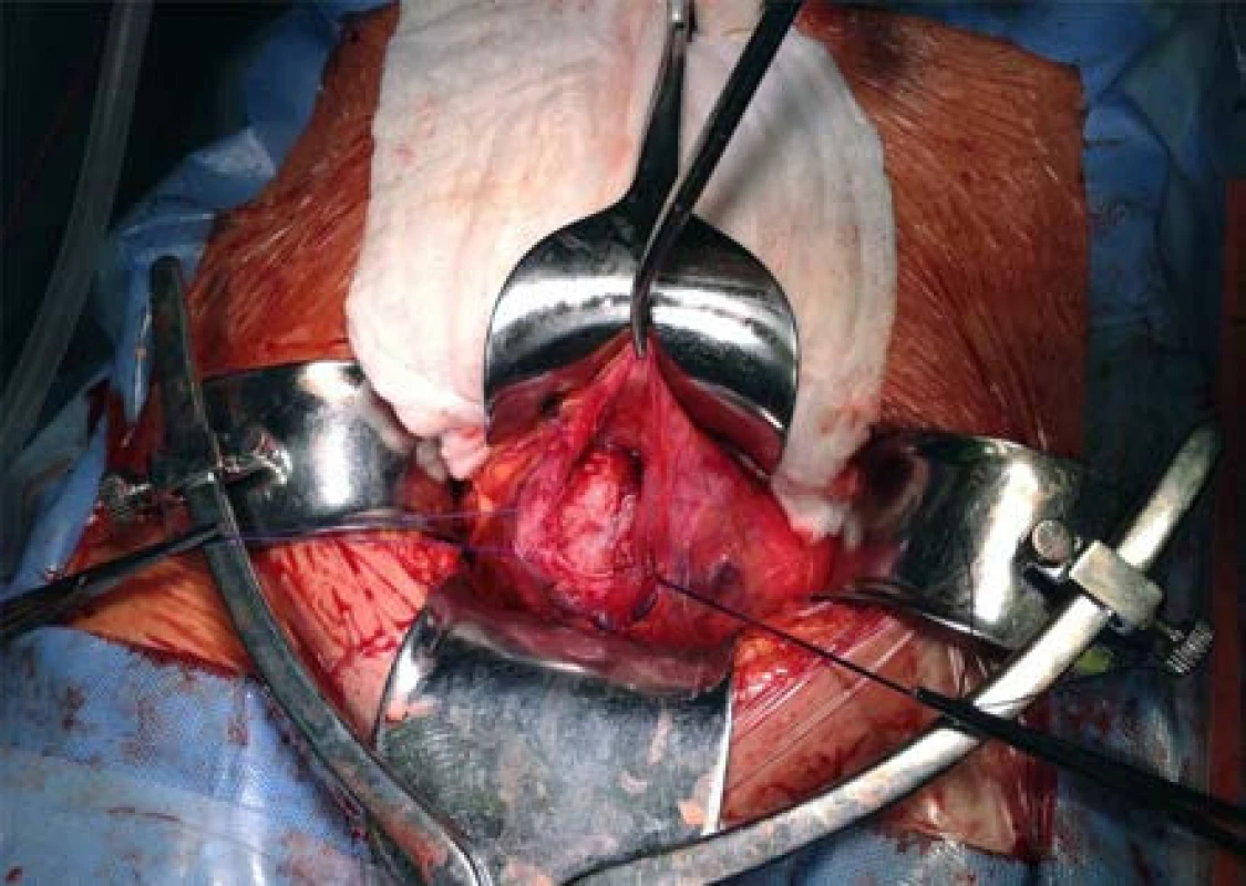 Peroperační nález leiomyomu v incidovaném močovém měchýři
Fig. 3. Intraoperative finding– leiomyoma localized in the urinary bladder