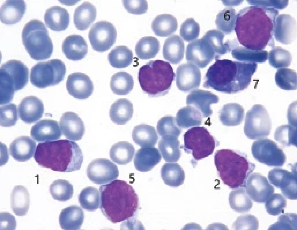 Cytologie kostní dřeně před léčbou: (FNHK, IV. interní hematologická klinika, hematologická laboratoř).
