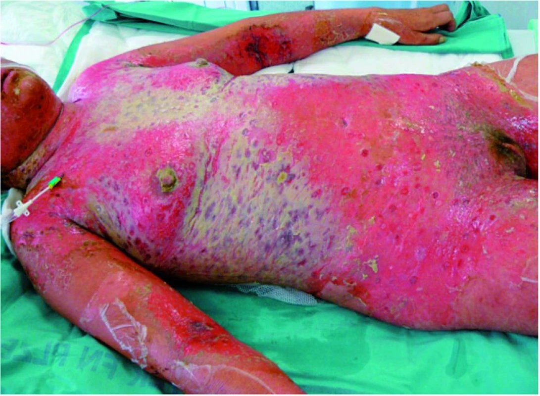 Toxická epidermální nekrolýza po léčbě amoksiklavem
