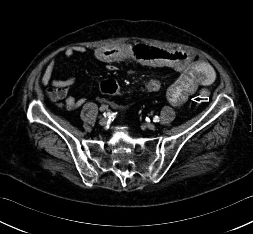 CT nález. Zhrubnutá stena jejuna (šípka).
Fig. 4. CT finding. Roughened jejunal wall (arrow).
