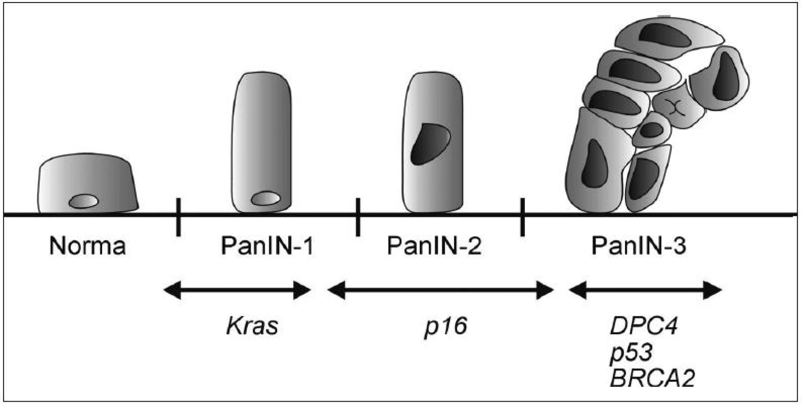 Model histologické a genetické progrese duktálního adenokarcinomu pankreatu