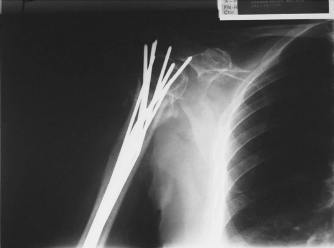 RTG obraz možné komplikace osteosyntézy podle Zifka – proximální migrace K-drátů
Fig. 7. X-ray view of a potential complication of the osteosynthesis according to Zifko – proximal migration of the K- wires
