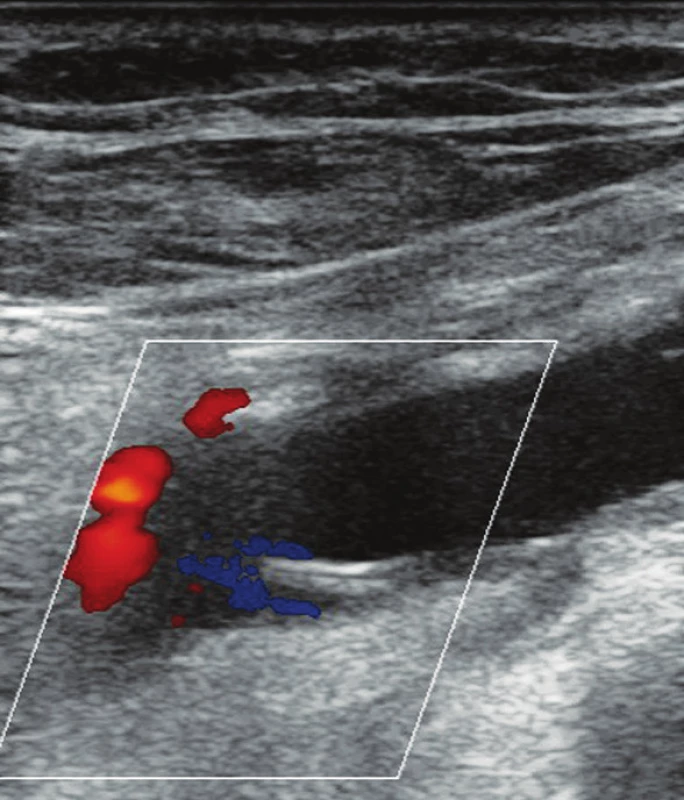 Zobrazená arteria poplitea v pozdĺžnom reze. Viditeľný „intimal flap“ – vlajúca intima
Fig. 4. The popliteal artery – longitudinal section. “Intimal flap“ is detectable