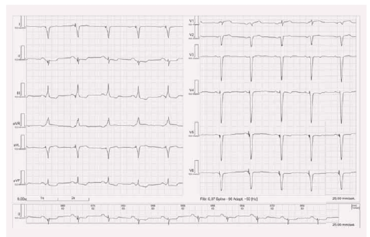 EKG stimulace biventrikulární.