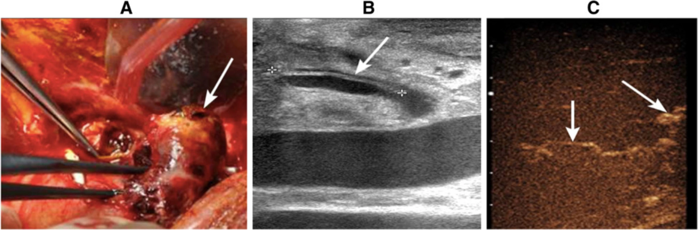 A blood clot that was 4 × 3 cm in size was found in the hilus hepatis during urgent exploratory laparotomy (<i>arrow</i>). b Hepatic artery dissection was identified by gray-scale ultrasound. c Intraoperative CEUS revealed the opening of collateral circulation