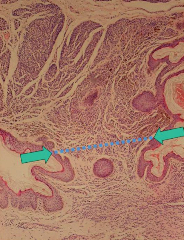 Pendulujúci intradermálny melanocytový névus (HE, 40x): reziduum névu (→) pod líniou rezu (modelová situácia na kompletne odstránenom néve)
