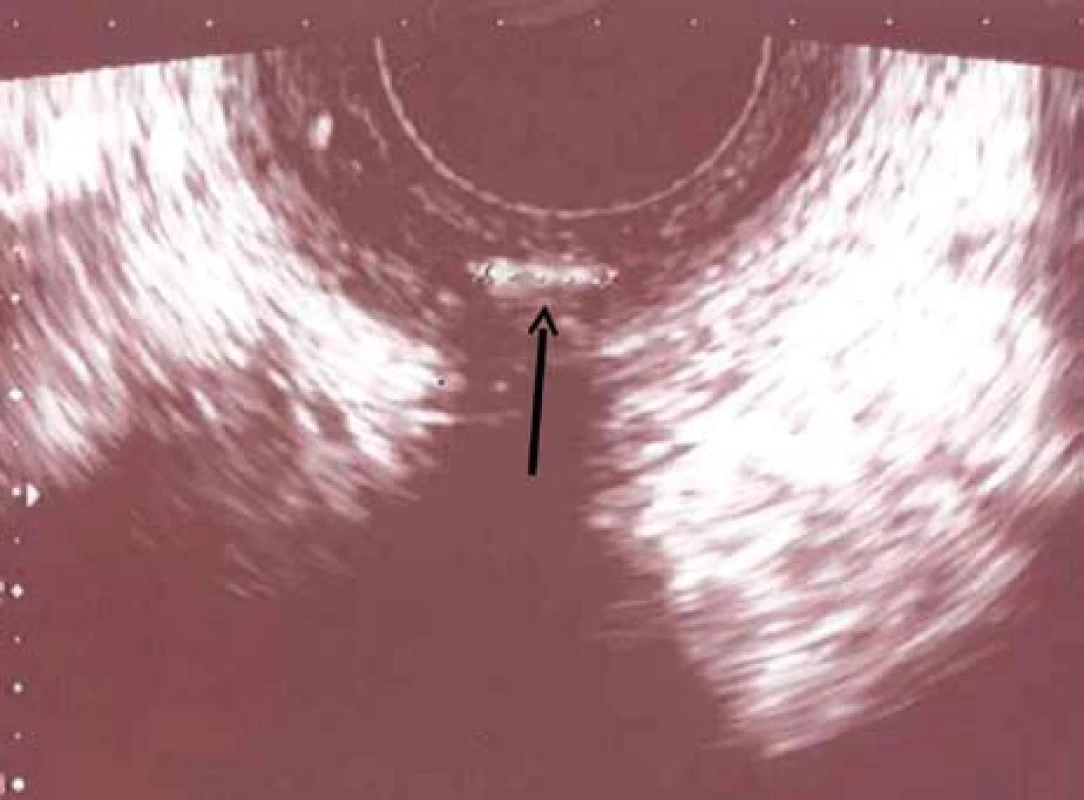 Anorektální endosonografie u nemocné s transsfinkterickou píštělí (šipka).
Fig. 3. Ano-rectal endosonography in a patient with transsfincteric fistula (arrow).