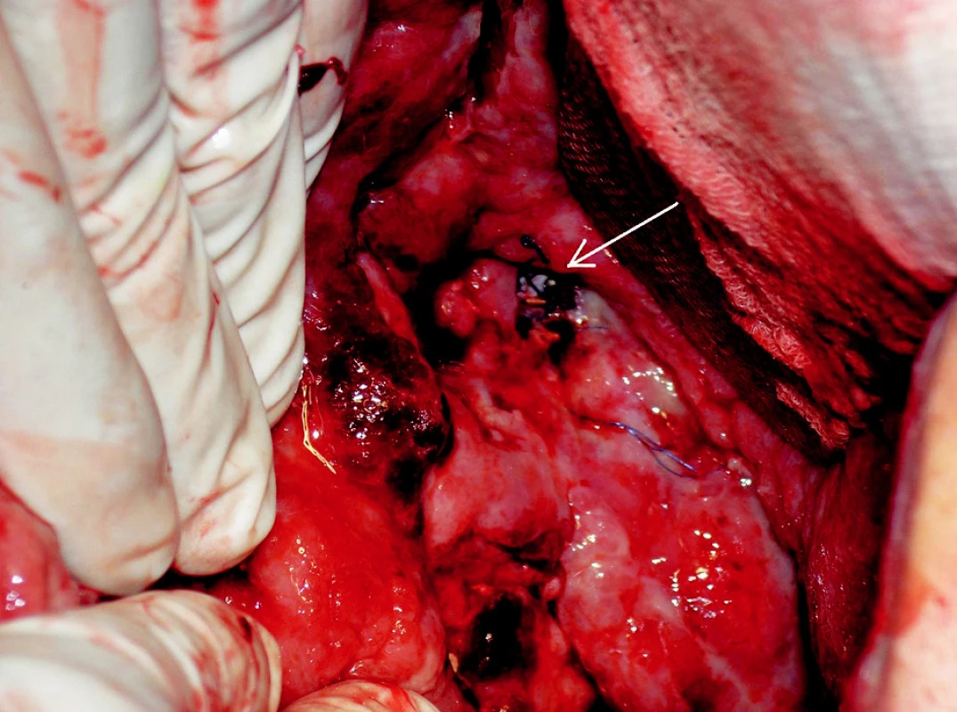 Snímek chirurgické revize. Na spodině dutiny je v defektu žilní stěny patrný stengraft (šipka)
Fig. 4. Surgical revision view. The introduced stent is visible through a venous wall defect (arrow)