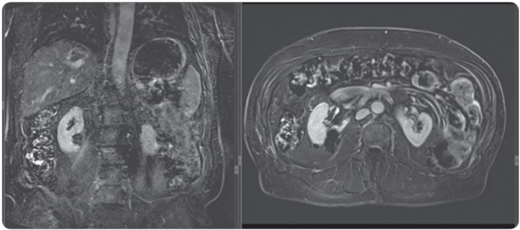 MRI (post intra-venous gadolinium injection) in coronal and axial sequences at 6 months follow-up showing complete tumor  necrosis without any signs of tumor remnants.