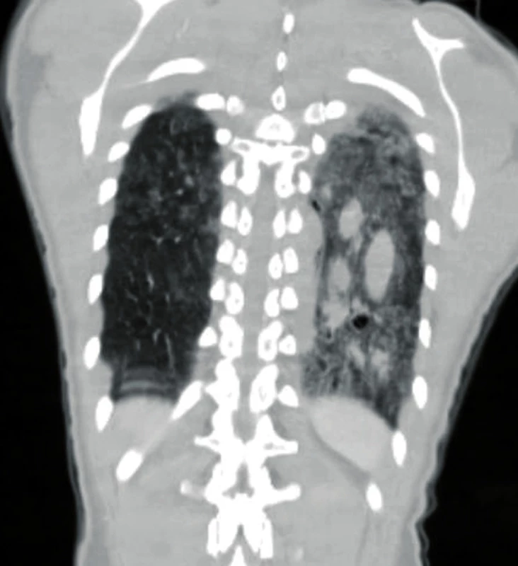 Coronal CT