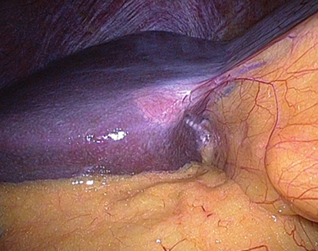 Laparoskopický pohled na barevně odlišnou pseudolézi v segmentu S4b
Figure 3: Laparoscopic view of the different-coloured pseudolesion in segment S4b