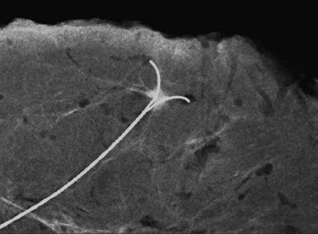 <em>Specimen radiography</em> – lokalizace cípaté léze maligního vzhledu velikosti 4 mm, 52letá žena. Histologicky prokázán smíšený duktální a lobulární invazivní karcinom Grade 3, estrogenové receptory slabě pozitivní, progesteronový receptor negativní67, ki67 17%, Her2 +.