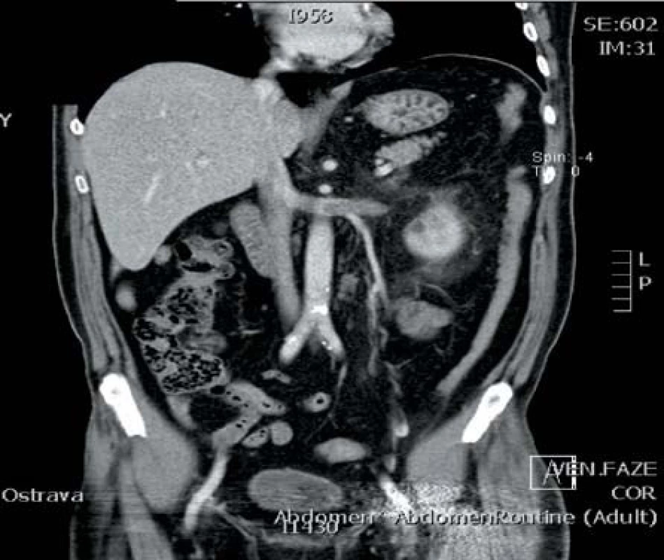 Nádorový trombus levé renální žíly zasahující v době vyšetření do úrovně aorty
Fig. 2. Tumor trombus limited to the left renal vein