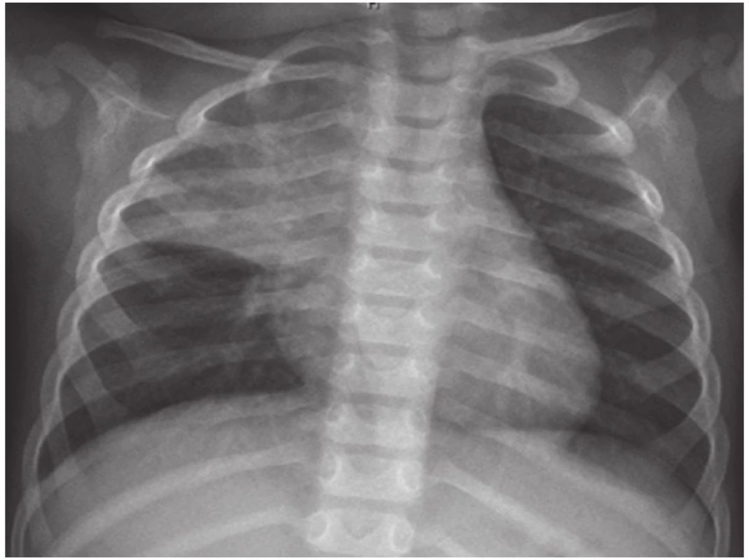 RTG snímek plic s atelektázou po 12 týdnech antituberkulózní terapie.
Fig. 3. Chest X-ray of infant with atelectasis after 12 weeks of treatment.