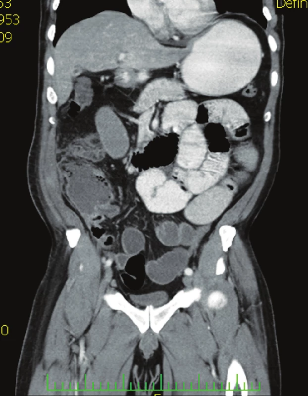 CT vyšetření břicha s nálezem ohraničené kolekce tekutiny v ileocékální krajině
Fig. 3. Abdominal CT examination showing defined fluid collection within the ileocaecal region