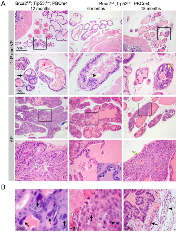 Combined deletion of <i>Brca2</i> and <i>Trp53</i> leads to HG PIN.