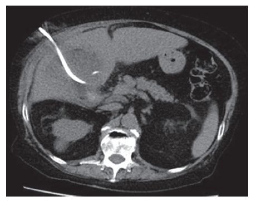Transhepatická perkutánní drenáž žlučníku
Fig. 1: Percutaneous transhepatic gallbladder drainage