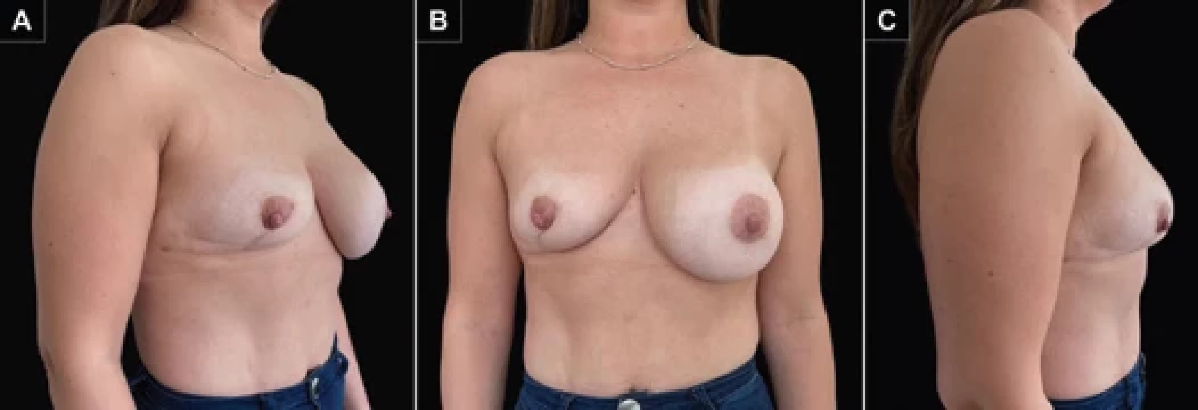 Image following surgical debridement and completed targeted antibiotic treatment. A) Right oblique view; B) front view; C) right side view.