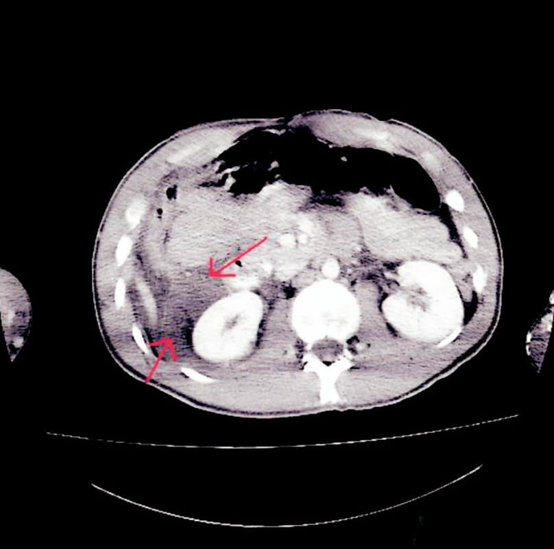 CT snímek – zvětšení množství tekutiny v hepatorenálním prostoru vpravo
Fig. 2. CT view – more fluid in the right hepatorenal region