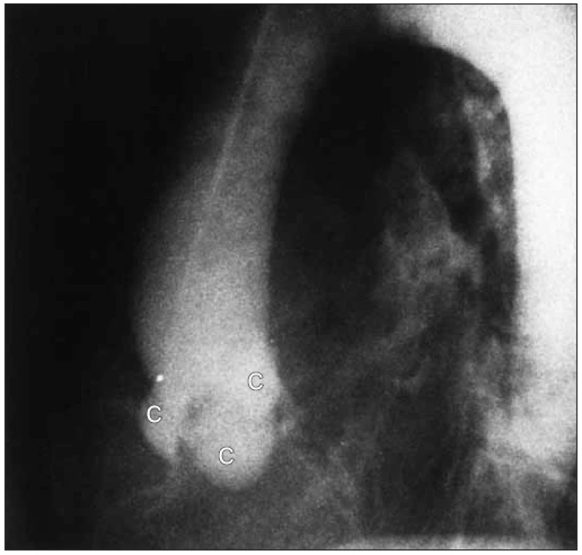 Boční angiogram u aortální stenózy ukazuje ztluštělé rigidní cípy aortální chlopně