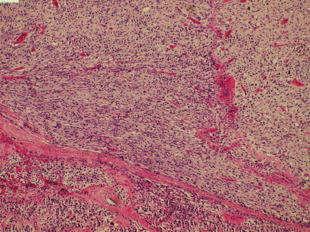Histologický obraz resekátu
Fig. 3: Histological image of EGIST resecate