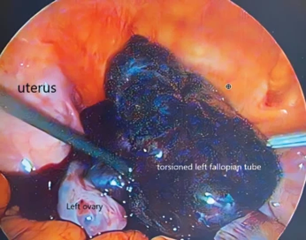 Isolated left fallopian tube torsion in the reproductive period.