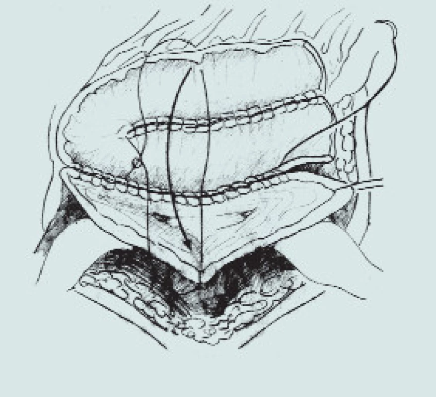 Sigmoideální augmentace.
(A – izolace sigmoidea se zachováním výživy větví a. colica inferior, B – izolace sigmoidea s použitím stoperu, C – rekonfigurace detubularizovaného sigmoidea a anastomóza s rozpolceným m. měchýřem)