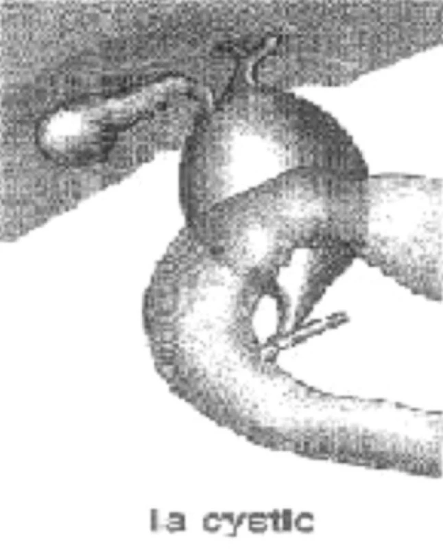 Operačný nález cysty podľa klasifikácie
Pic. 8. Aperoperative finding of a cyst according to the classification