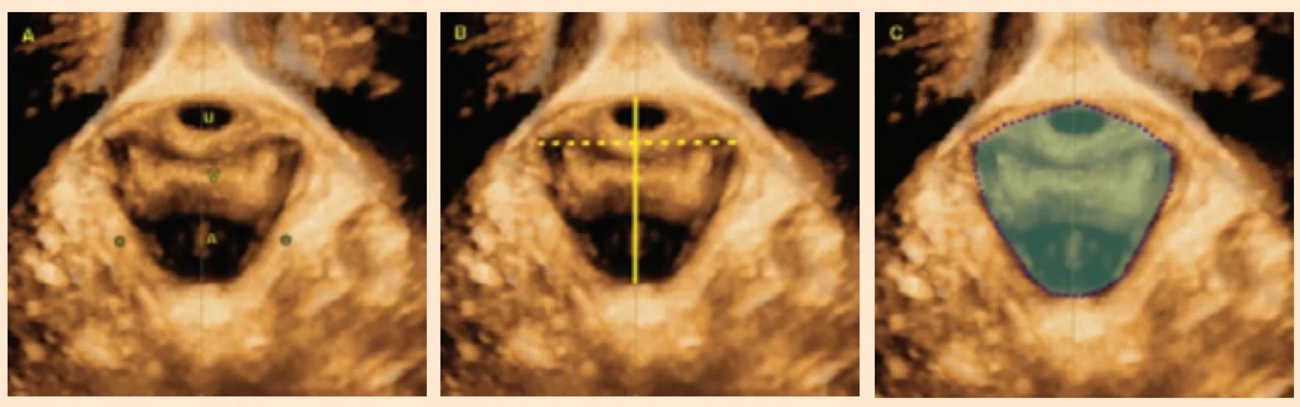  Zobrazení genital hiatus pomocí 3D TPUS. A) U – uretra, V – pochva, A – anální kanál, * – musculus puborectalis. B) Plná žlutá čára – anteroposteriorní rozměr (APD), přerušovaná žlutá čára – příčný průměr hiátu (HTD). C) Modrá plocha – plocha genitálního hiatu (HA). TPUS – transperineální ultrazvuk Fig. 2. Visualization of the genital hiatus using 3D TPUS. A) U – urethra, V – vagina, A – anal canal, * – puborectalis muscle. B) Solid yellow line – anteroposterior diameter (APD), dashed yellow line – hiatal transverse diameter (HTD). C) Blue area – genital hiatus area (HA).
