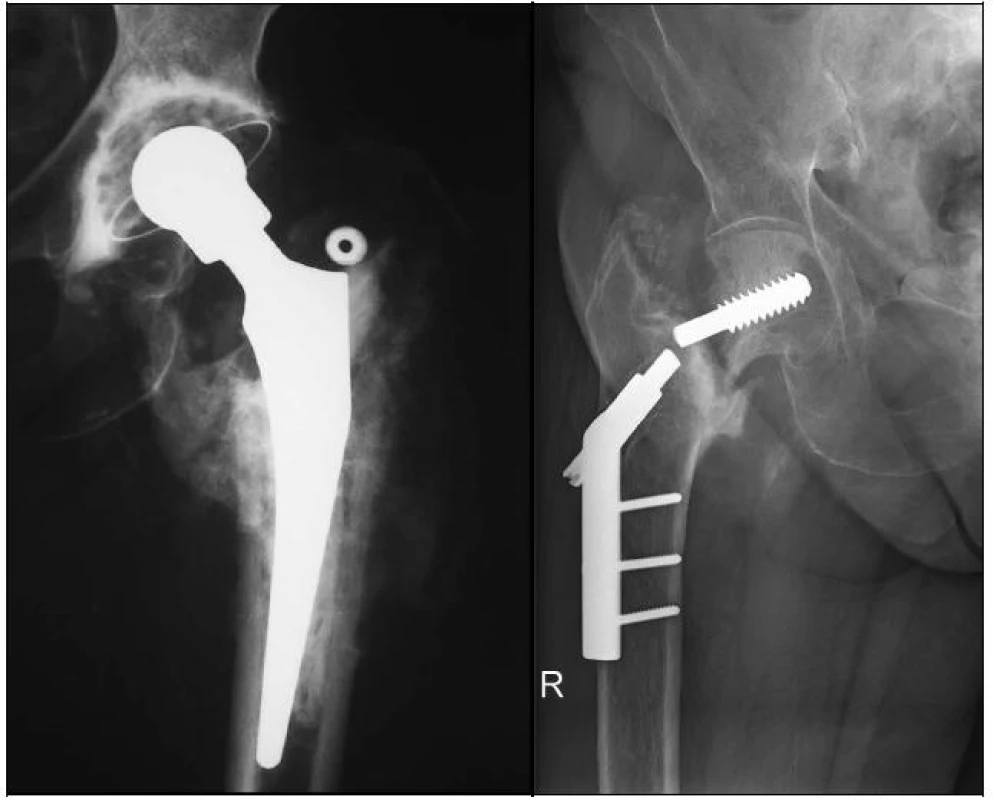 RTG dokumentace 65leté pacientky s primárně technicky špatně provedenou osteosyntézou
a - šroub DHS je zaveden příliš proximálně až mimo hlavice femuru, poškozuje acetabulum 
b - stav 2 roky po konverzi na cementovanou TEP, protéza je bez známek uvolnění