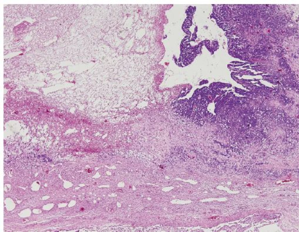Solidně utvářený rozsáhle nekrotický tumor tvořený menšími a středními oválnými buňkami, z části s minimem cytoplazmy, v tumoru jsou velmi četné mitozy včetně atypických, na periférii tumoru je infiltrativní růst. Místy je tumor i v luminech cév.