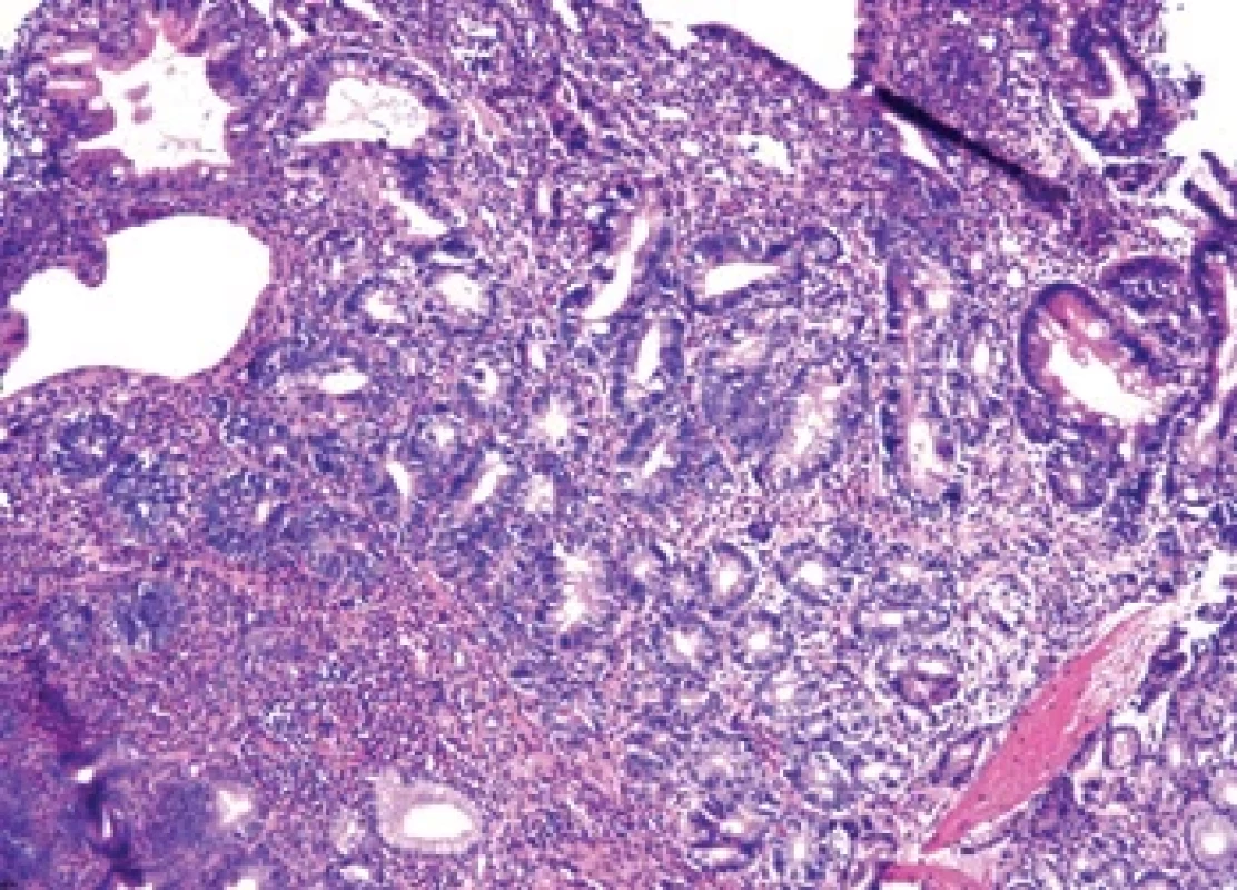 Biopsie antrální žaludeční sliznice se známkami chronické aktivní gastitidy s okrsky kompletní intestinální metaplazie (vpravo nahoře) a s přechodem do high- -grade dysplazie ve žlázkách (vlevo/dole). Barvení: hematoxylin-eozin, zvětšení 100×. Fig. 􀍸. Biopsy of the antral gastric mucosa with signs of chronic active gastritis with areas of complete intestinal metaplasia (top right) and transition to high-grade dysplasia in the glands (left/bottom). Staining: hematoxylin-eosin, magnifi cation 100×.