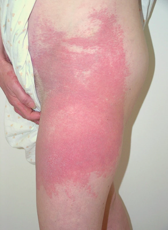 Fotoalergická kontaktní dermatitida (ketoprofen).