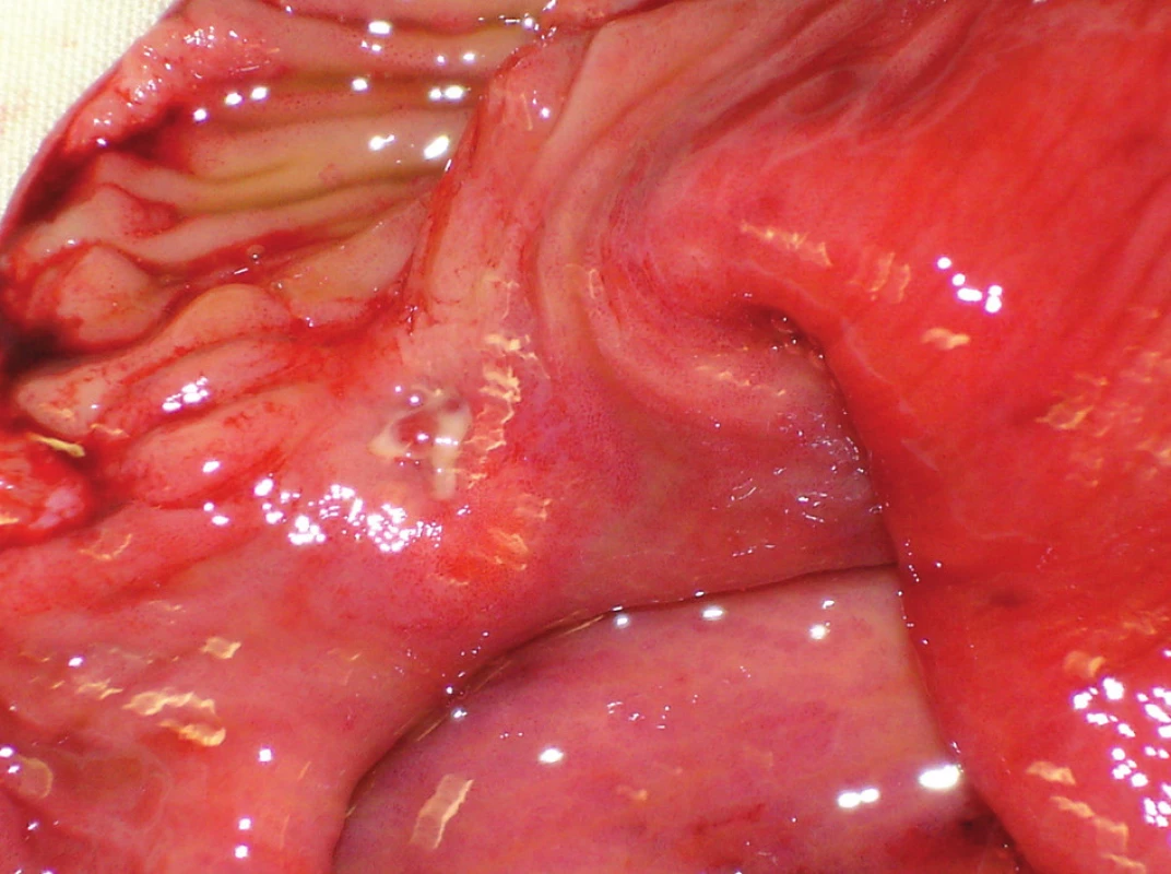 Defekt sliznice s prorůstajícím karcinoidem
Fig. 2: Mucosal defect with a carcinoid
