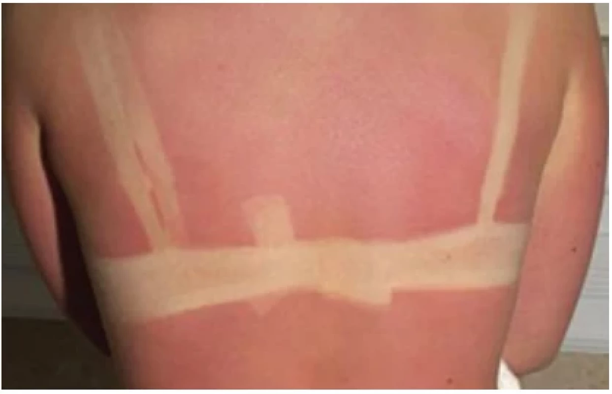 Popálená plocha I. stupně u dospělé pacientky. Fig. 1. First-degree burn area in an adult patient.