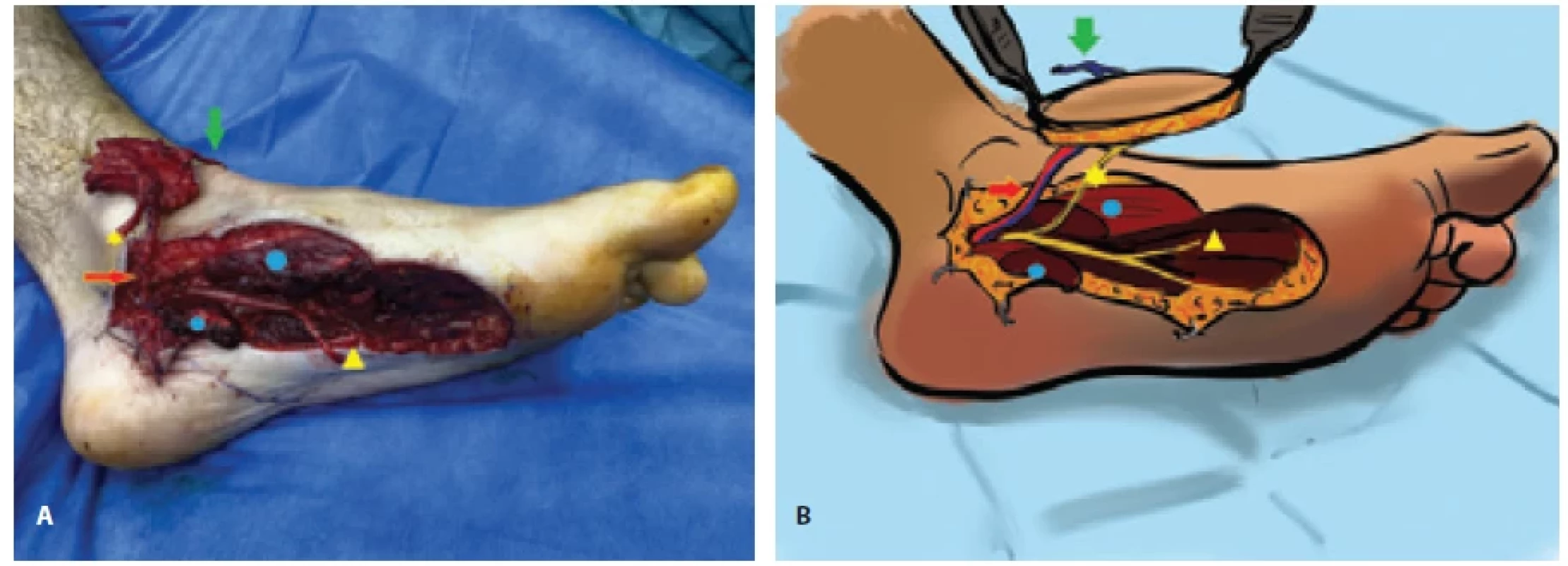 A) Medial plantar artery fl ap elevated and still attached to the source vessels; B) schematic representation. The following elements are detailed: abductor hallucis sectioned muscle (blue circle), medial plantar vascular pedicle (red arrow), superfi cial vein of the fl ap (green arrow), medial plantar sensory nerve of the fl ap after interfascicular dissection (yellow star) and recipient nerve stump of the sensory branch of the medial plantar nerve (yellow triangle).